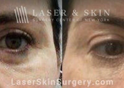 Botox brow lift to raise the brows and open the eyes