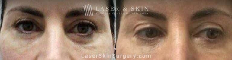 Botox brow lift to raise the brows and open the eyes