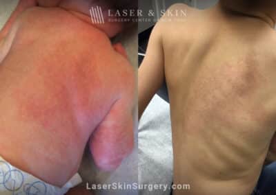 Laser treatments to minimize congenital vascular malformation on child’s back