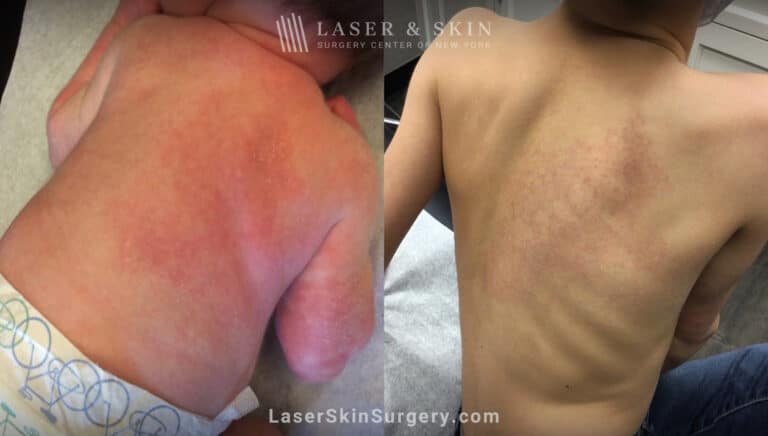 Laser treatments to minimize congenital vascular malformation on child’s back