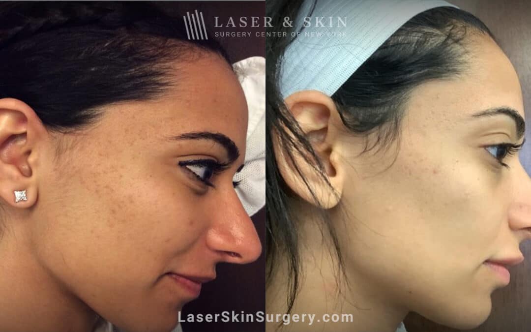 laser acne scar treatment before and after