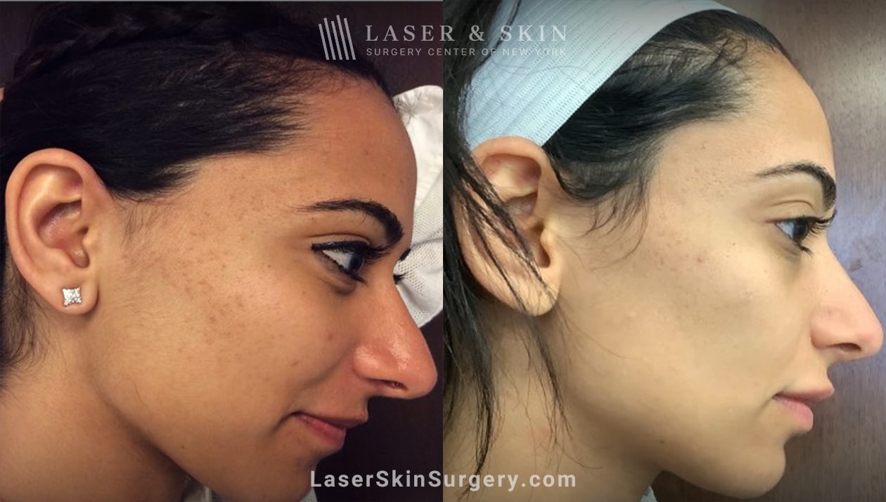 laser acne scar treatment before and after