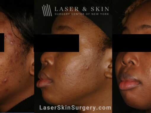 Accure laser treatments for acne scars