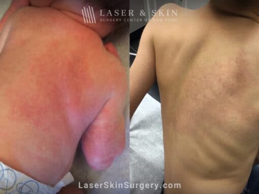 Laser treatments to address congenital vascular malformation on child’s back
