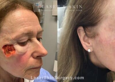 Melanoma reconstruction to remove skin cancer and reduce scarring