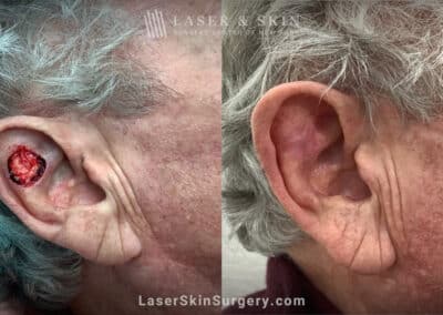 Mohs surgery to treat skin cancer on the ear