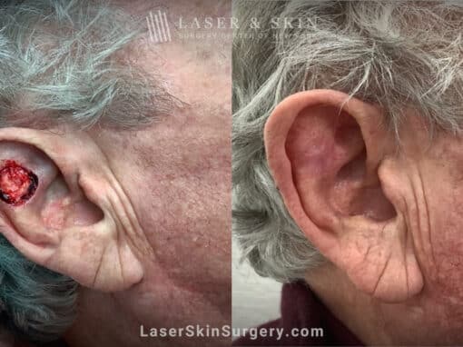 Mohs surgery to treat skin cancer on the ear