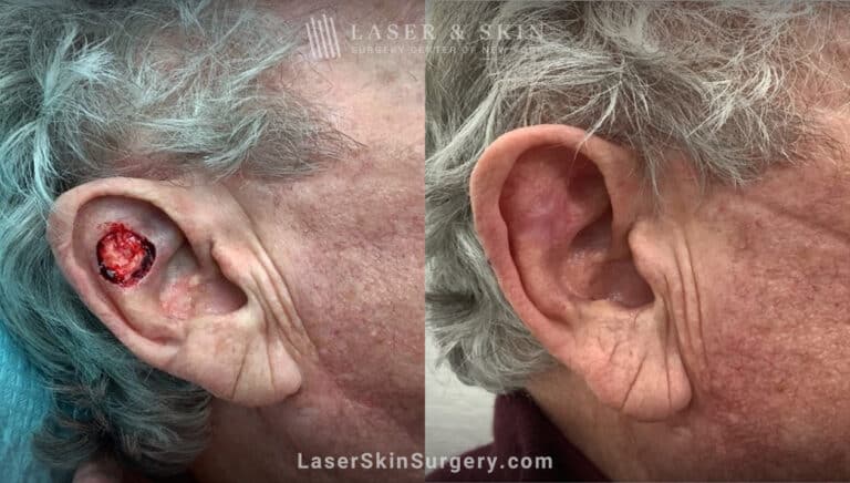 Mohs surgery to treat skin cancer on the ear