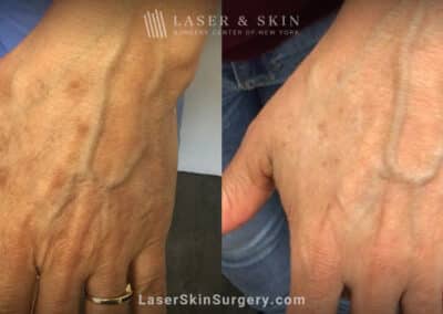 Ruby laser treatment to rejuvenate the hands