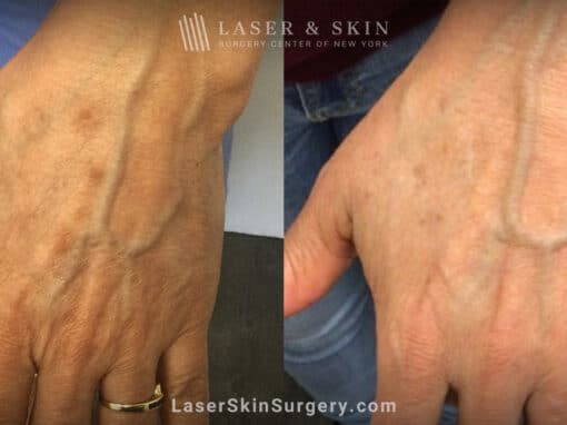 Ruby laser treatment to rejuvenate the hands