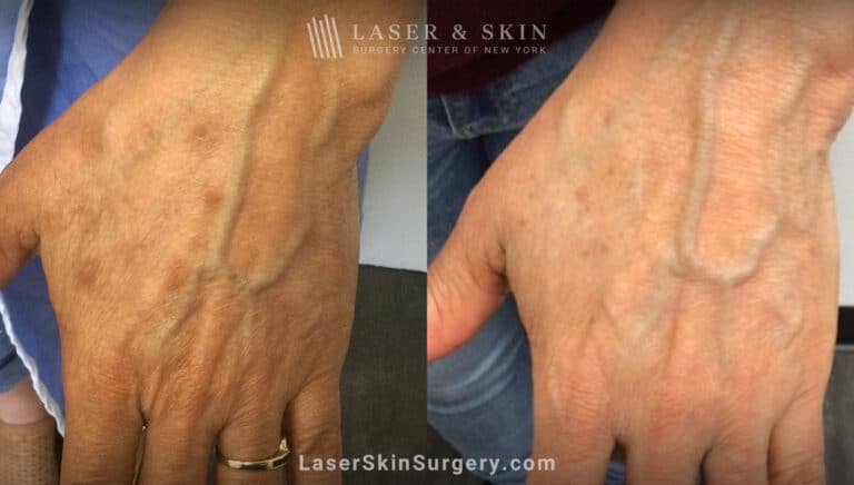 Ruby laser treatment to rejuvenate the hands