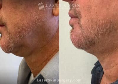Kybella to minimize fat beneath the chin