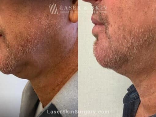 Kybella to minimize fat beneath the chin