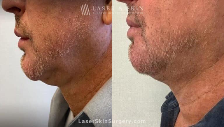 Kybella to minimize fat beneath the chin