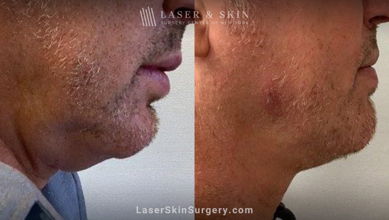 Non-Invasive Double Chin Reduction