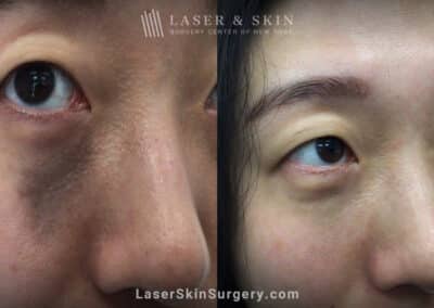 Picoplus treatments to reduce pigmentation beneath the eye