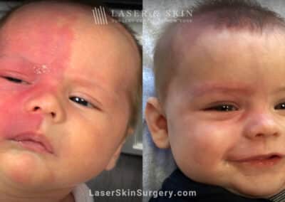 Vbeam prima laser to treat port wine birthmark on infant’s face