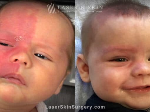 Vbeam prima laser to treat port wine birthmark on infant’s face