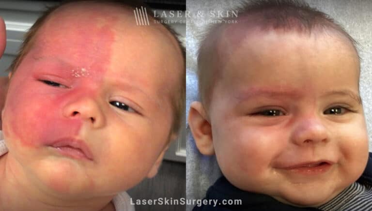 Vbeam prima laser to treat port wine birthmark on infant’s face