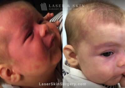 Vbeam prima laser to treat port wine birthmark from infant’s face