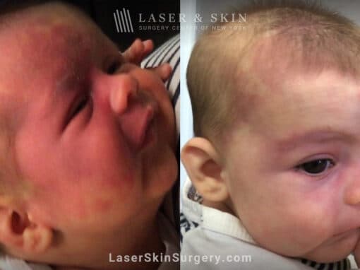 Vbeam prima laser to treat port wine birthmark from infant’s face