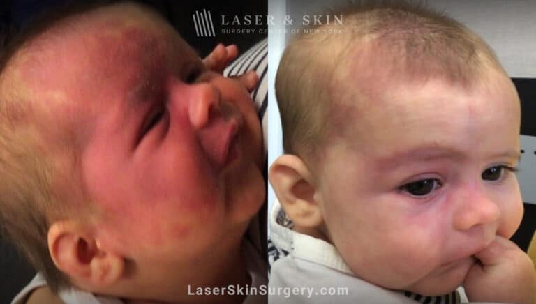 Vbeam prima laser to treat port wine birthmark from infant’s face