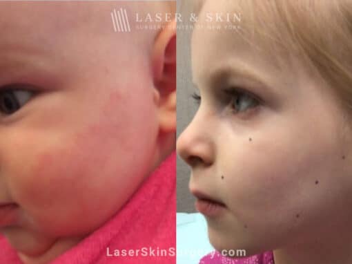 Vbeam prima treatments to minimize vascular birthmark