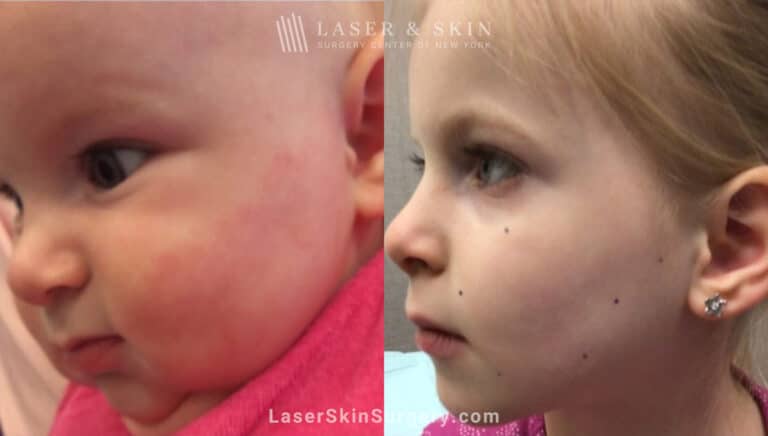 Vbeam prima treatments to minimize vascular birthmark