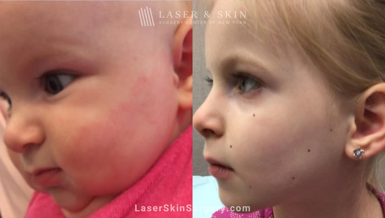 Vascular & Pigmented Birthmarks New York, NY Laser Center