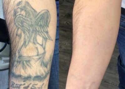 PicoPlus Laser to Remove Tattoo from Forearm