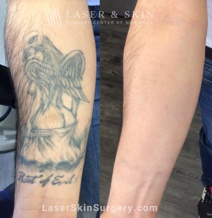 PicoPlus Laser to Remove Tattoo from Forearm