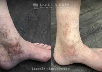 PicoPlus Laser to Treat Brown Spots on the Ankle
