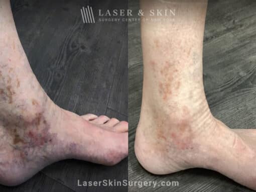 PicoPlus Laser to Treat Brown Spots on the Ankle