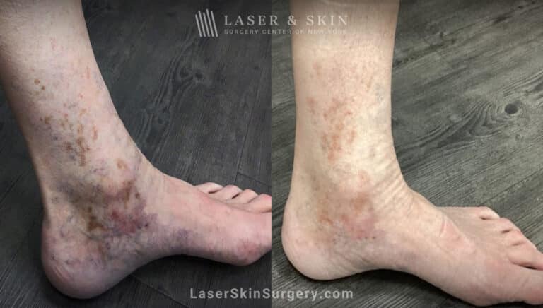 PicoPlus Laser to Treat Brown Spots on the Ankle