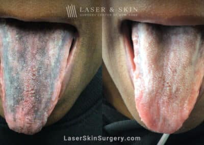 Ruby laser to treat tongue pigmentation