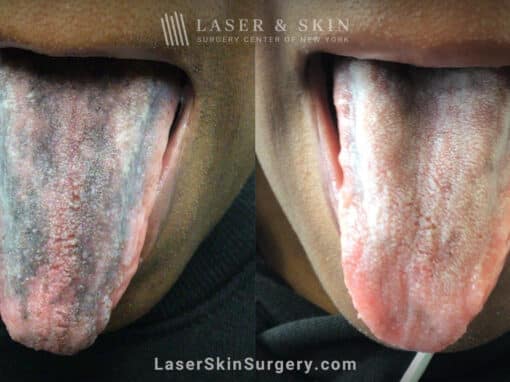 Ruby laser to treat tongue pigmentation