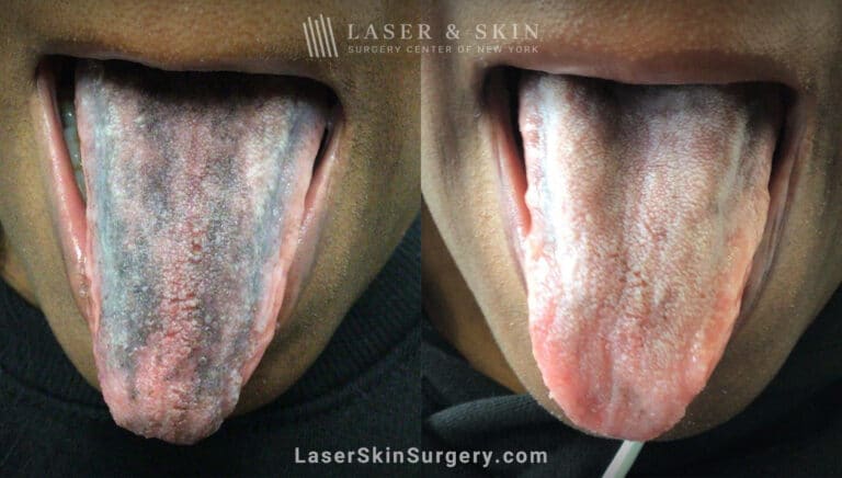 Ruby laser to treat tongue pigmentation