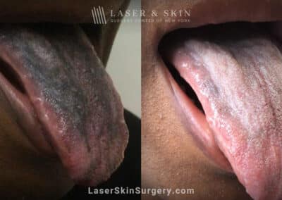 Ruby laser to treat tongue pigmentation