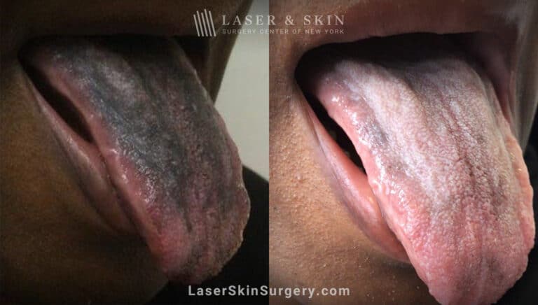 Ruby laser to treat tongue pigmentation