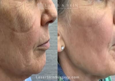 CO2 Laser for Skin Rejuvenation and a Smoother Complexion