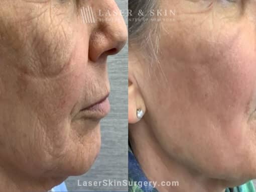 CO2 Laser for Skin Rejuvenation and a Smoother Complexion