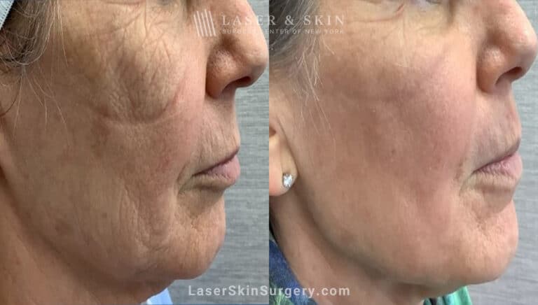 CO2 Laser for Skin Rejuvenation and a Smoother Complexion