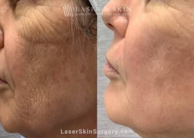 CO2 Laser for Skin Rejuvenation and a Smoother Complexion
