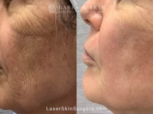 CO2 Laser for Skin Rejuvenation and a Smoother Complexion