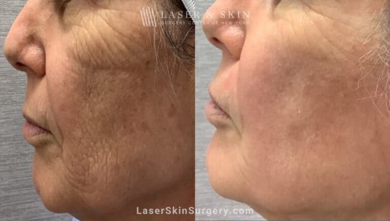 CO2 Laser for Skin Rejuvenation and a Smoother Complexion