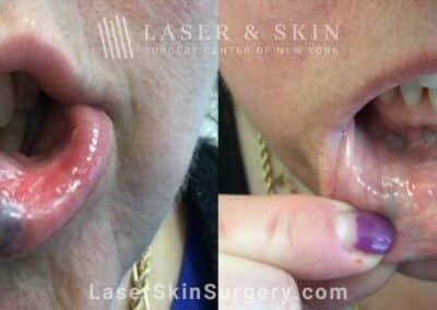 Excel V Treatments for Venous Malformation on the Lip