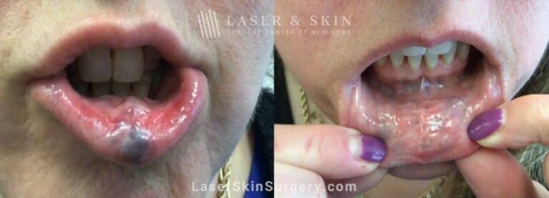 Excel V Treatments for Venous Malformation on the Lip