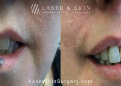 Excel V Treatments for Venous Malformation on the Lip