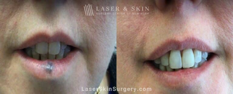 Excel V Treatments for Venous Malformation on the Lip