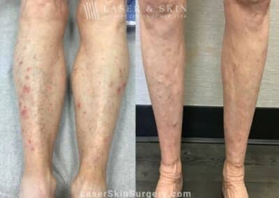 Fraxel for Skin Rejuvenation on the Legs